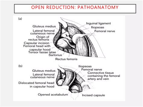 3a ddh open reduction principles & protocols | PPT