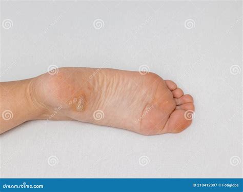 Plantar Wart Close Up on the Bottom of a Female Foot Heel Caused by the Human Papillomavirus, or ...