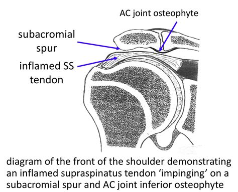 What Is A Spur In Your Shoulder at Modesto Kellogg blog