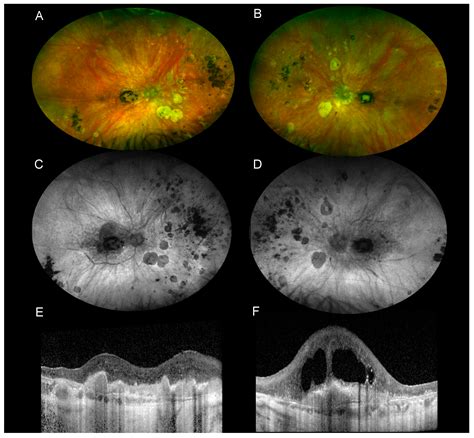Birdshot Chorioretinopathy: A Review | MDPI