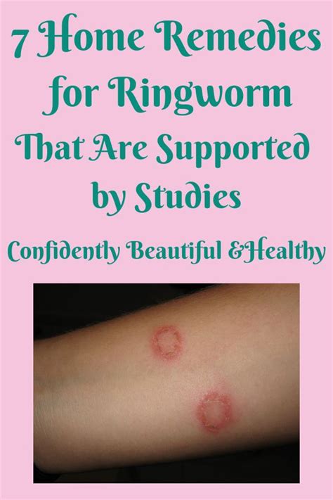 home remedies ringworm