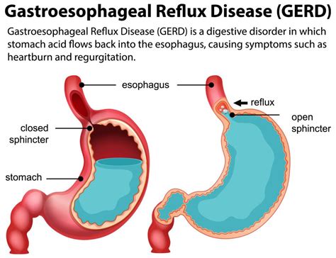 GERD (Gastroesophageal Reflux Disease): When Stomach Acid Affects the ...