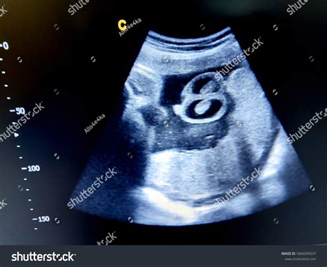 Fetal Hydrocele Testis By Ultrasound Stock Photo 1666939237 | Shutterstock - fluid in testicles
