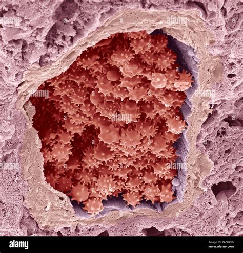 Crenated red blood cells. Coloured scanning electron micrograph (SEM ...