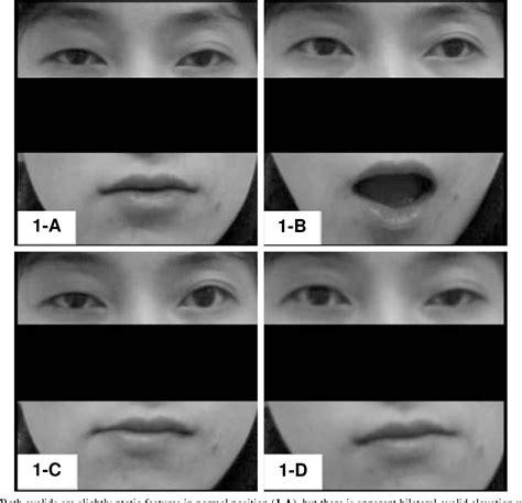 Figure 1 from A Case of Bilateral Marcus Gunn Jaw Winking Phenomenon | Semantic Scholar