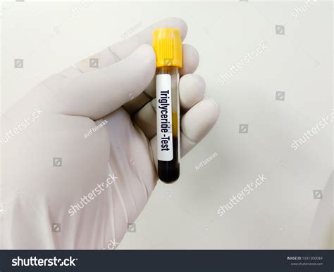 Blood Sample Triglyceride Test Medical Laboratory Stock Photo (Edit Now) 1931300084