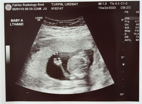 Baby Boy Ultrasound At 16 Weeks at Janet Simmons blog
