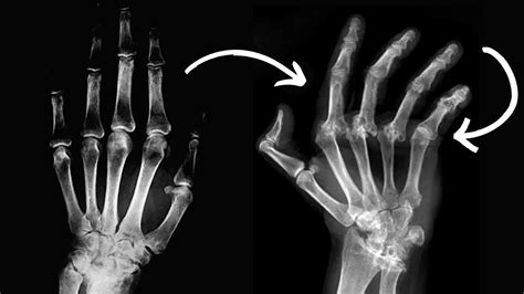 Descubren que un fármaco común mejora los síntomas de la artritis de manos