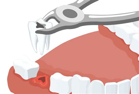 Tooth extraction | Dentist Doncaster