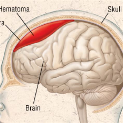 Subdural Hemorrhage