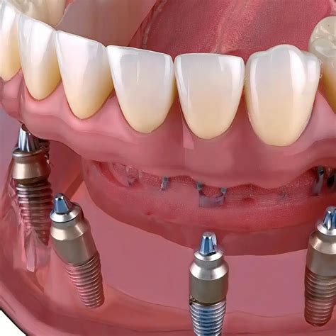 All on 4 dental implants: Immediate-loading