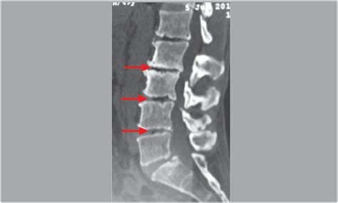 Herniated Disc Vacuum Phenomenon at Tonya Barnes blog