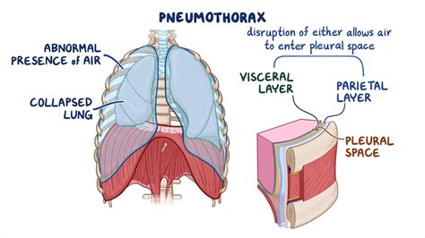 Pneumothorax: Clinical sciences - Osmosis Video Library