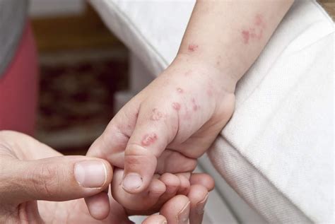 Scabies pada Bayi: Ciri-Ciri dan Cara Mengatasinya