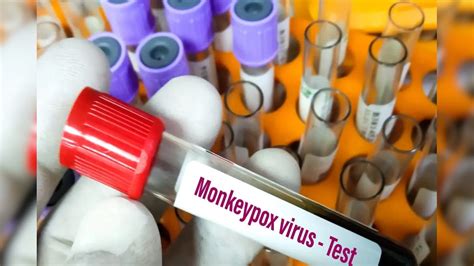 OMG: ઈટાલીના દર્દીને કોરોના, મંકીપોક્સ અને HIVનો એક સાથે ચેપ લાગ્યો ...