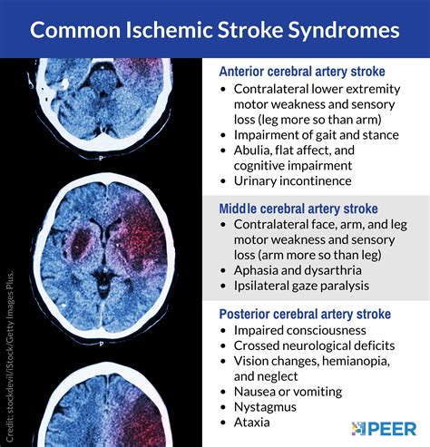 Middle Cerebral Artery Stroke