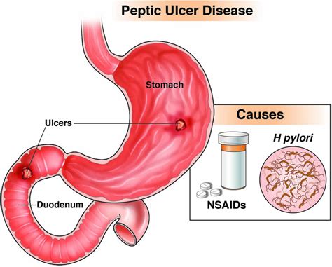 Peptic Ulcer Disease Specialists