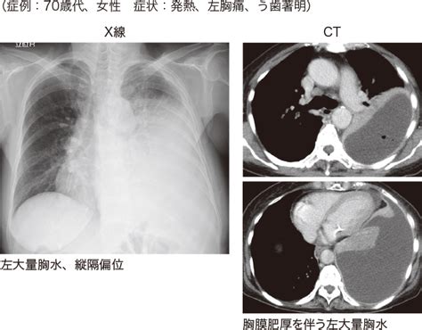 膿胸 | 看護roo![カンゴルー]