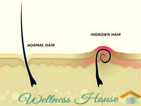Understanding Ingrown Hairs: Why Hair Appears Under the Skin After Waxing