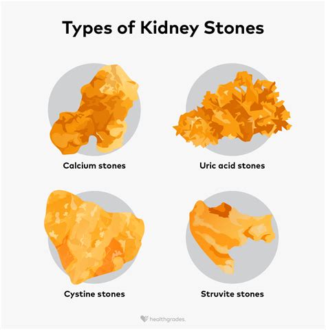 Types of Kidney Stones: Definitions, Symptoms, and Treatments