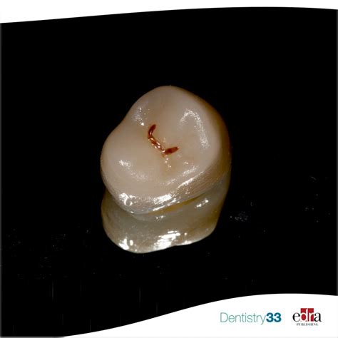Thickness of lithium silicate crowns reinforced with zirconia: the effect on failure modes ...