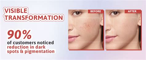 Glamveda 2% Kojic Acid Gel Cream with Niacinamide & Alpha Arbutin ...