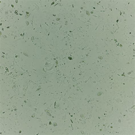 Hyaline Casts: Identification & Clinical Significance - MedLabBuddy