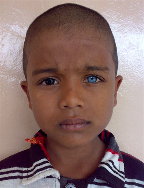 What Is It Called When You Have Two Different Colors In Your Eyes at ...