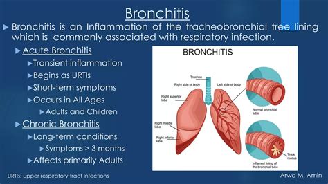 Bronchitis: An overview | PDF