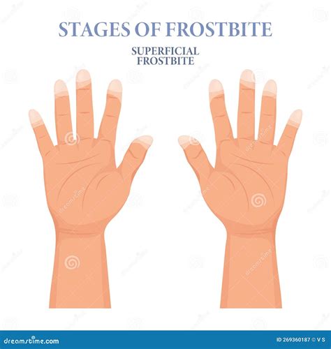 Frozen Hands in Different Stages. Medical Frostbite. Stages of Frostbite of Fingers. Medical ...