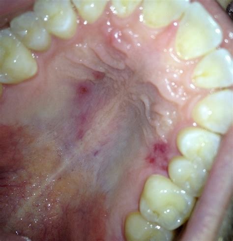 Red spots on the roof of mouth. Possible nut allergy? Details in ...