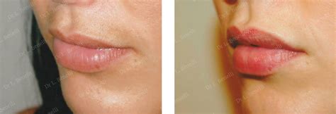 Bildergebnis für top+lip+surgeons