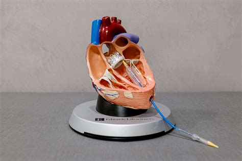 Left Atrial Appendage Occlusion - Hadjipetrou Cardiology