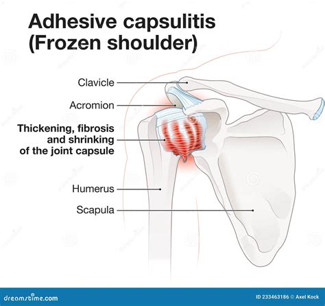 Frozen Shoulder. Adhesive Capsulitis. Illustration_5 Stock Illustration - Illustration of ...