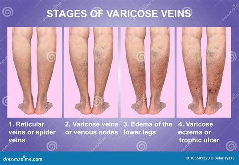 Varices En Una Pierna Mayor Femenina Foto de archivo - Imagen de eczema, vena: 105601320