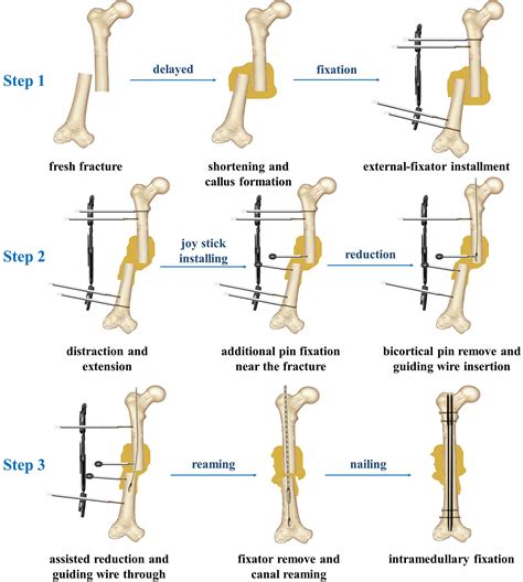 Intramedullary Nailing Simplified model of the IM nail (left) and the ...