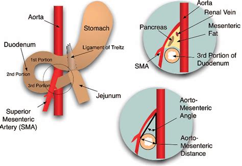 SMA syndrome causes, symptoms, diagnosis, treatment & prognosis