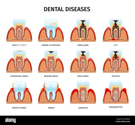 Teeth anatomy problems set with isolated compositions of tooth in jaw ...