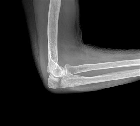 OrthoDx: Olecranon Fracture in Older Woman - Clinical Advisor