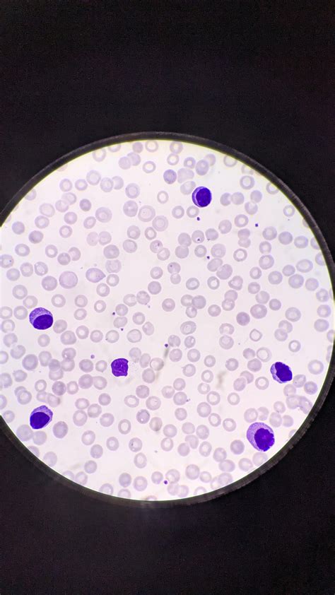 Plasma cell Leukaemia : r/Hematology