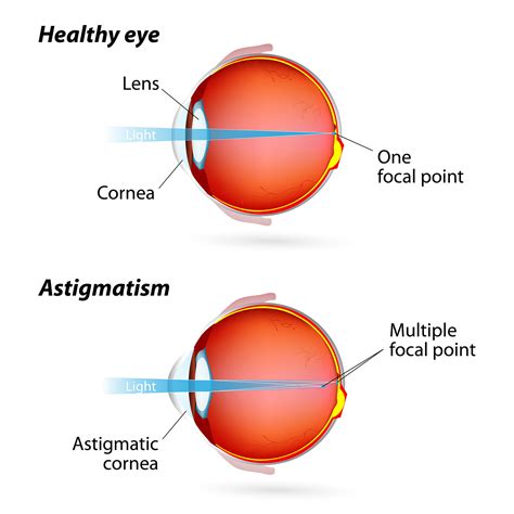 Can You Get LASIK with Astigmatism?