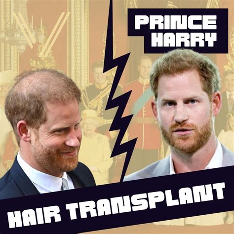 Kevin Costner's Hair Transplant: Before and After Result