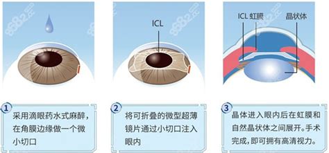 2023近视眼手术费用多少钱?CLC晶体植入3w+|全飞秒2w+|激光8q+,近视眼矫正-8682赴韩整形网