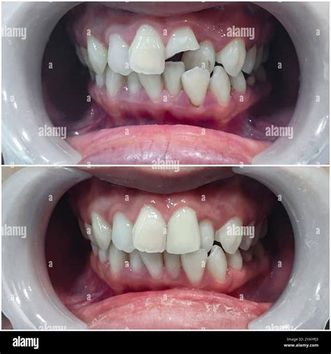 Fractured Front Tooth Repair