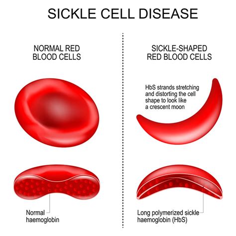 Types Of Sickle Cell Disease