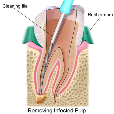 How Endodontics Is Performed - Boulder CO Dentist