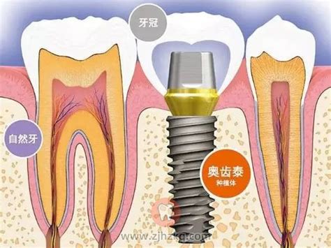 2022牙科种植牙收费价目表出炉 包含各类种植体价格 - 贝色口腔