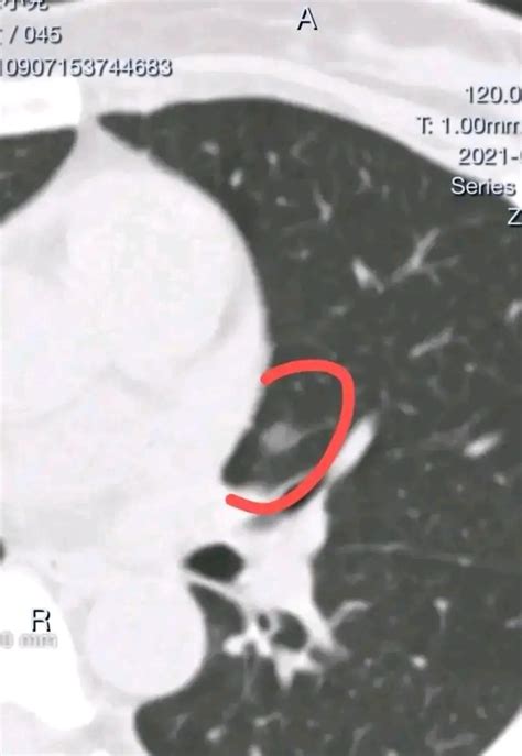 Does ground glass nodule lung cancer require lobectomy?Poorly positioned nodules can also be ...