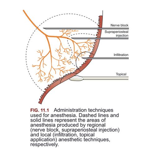 Local Anesthesia Blocks 的图像结果