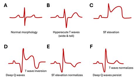 Myocardial Ischemia and Infarction – EKG Essentials: A Student Handbook